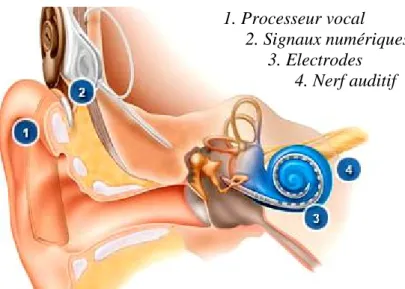 Figure 6 : Schéma du fonctionnement d’un implant cochléaire in vivo  [10] 
