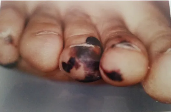 Figure 7: nodule d’Osler chez l’un de nos malades 