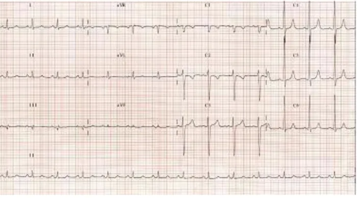 Figure 9 :    ECG dans une insuffisance aortique chronique volumineuse et ancienne :  hypertrophie ventriculaire gauche de type diastolique avec augmentation  de  l’amplitude  des  QRS  et  ondes  T  amples  et  positives  en  territoire  latéral (V5 et V6