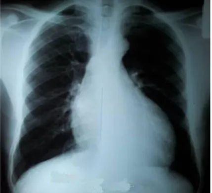 Figure 10 : Aspect d'insuffisance aortique avec hypertrophie ventriculaire   gauche modérée et débord de l'arc moyen droit