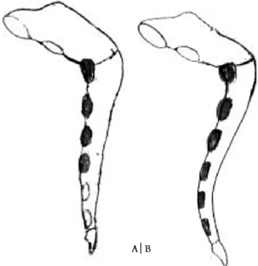 Figure 6 : A : Pectus arcuatum   B : Pectus arcuatum avec cuvette sous-jacente [26] 