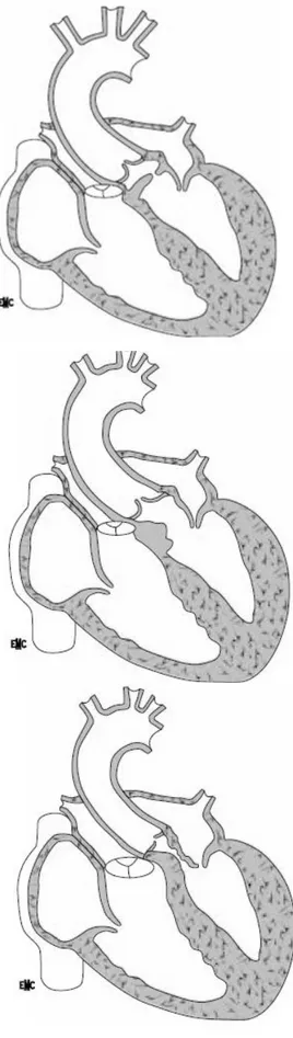 Figure 6 : classification de VOGT [26] 