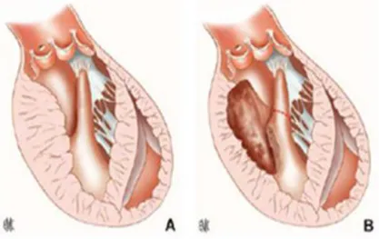 Figure 7 : Anomalie d’insertion du muscle papillaire directement sur la GVM  (A,B) 