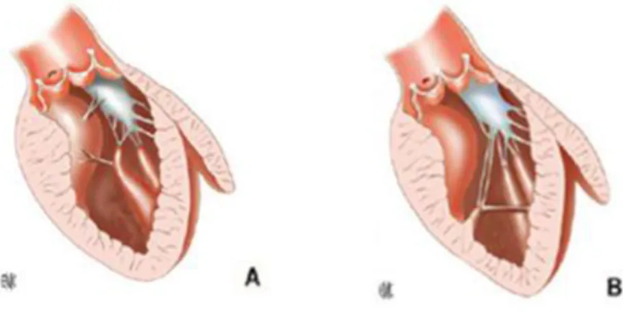 Figure 8 : A. Cordage anormale entre le pilier et le septum.  