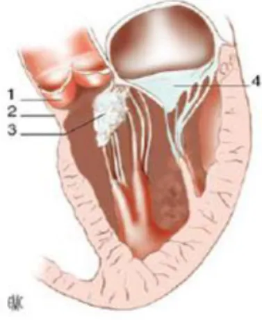 Figure 9 : Tissu valvulaire mitral accessoire. 