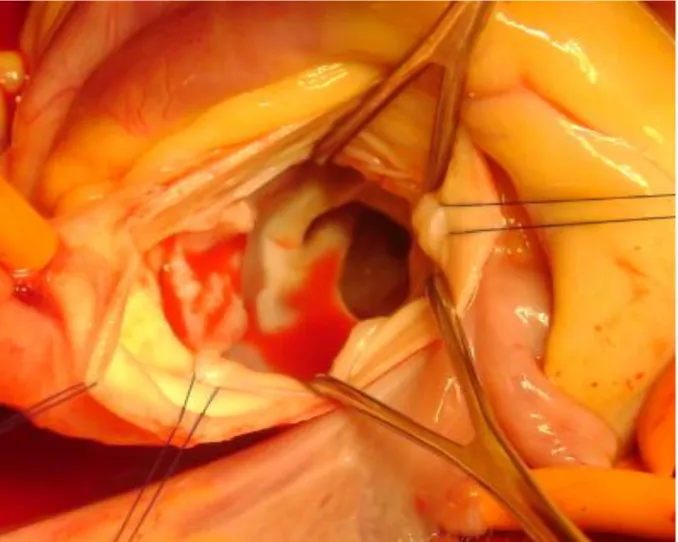 Figure 11 : Vue opératoire d’une anomalie mitrale associée au DSA :  Anomalie d’insertion du muscle papillaire directement sur la GVM