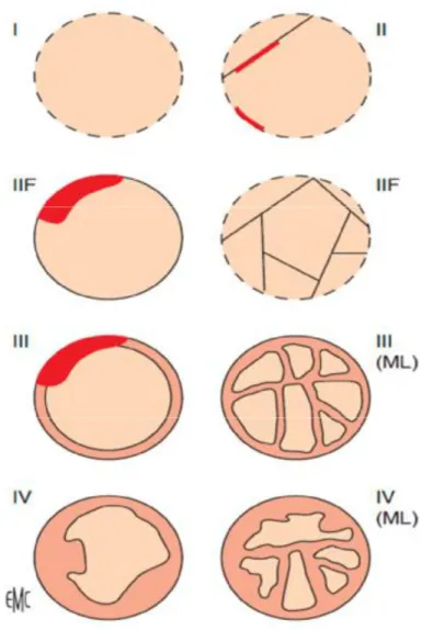 Figure 13. Représentation schématique de la classification de Bosniak [13]. F: follow-up  (surveillance); ML: multiloculaire 