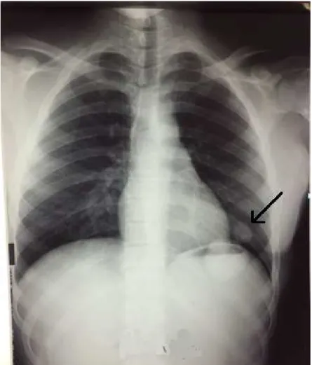 Fig. 13 : Radiographie thoracique montrant une opacité basithoracique gauche 