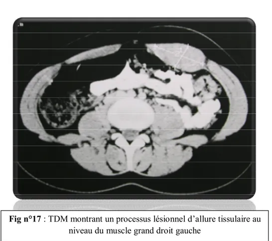 Fig n°17 : TDM montrant un processus lésionnel d’allure tissulaire au  niveau du muscle grand droit gauche 