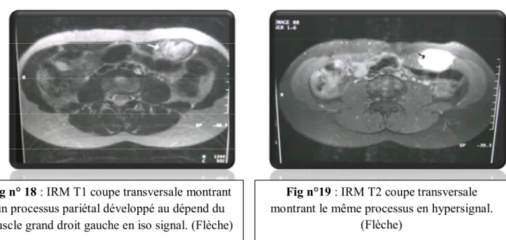 Fig n° 18 : IRM T1 coupe transversale montrant  un processus pariétal développé au dépend du  muscle grand droit gauche en iso signal