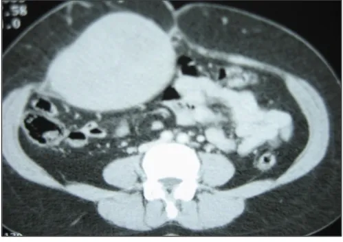 Fig n°22 : TDM montrant une masse du muscle grand droit  de densité tissulaire homogène rehaussée par le PC 