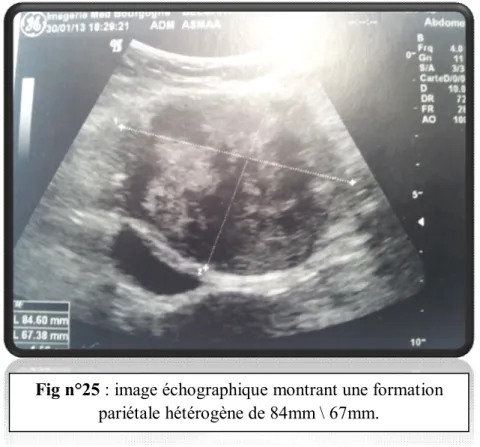 Fig n°25 : image échographique montrant une formation  pariétale hétérogène de 84mm \ 67mm