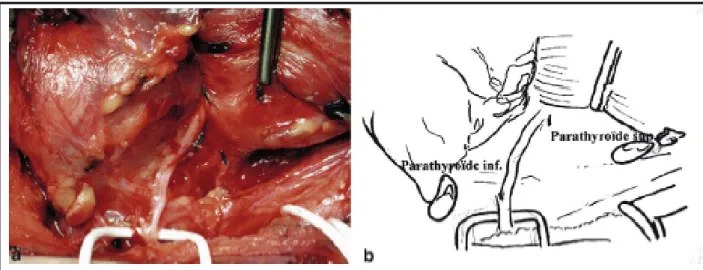 Fig. 5. a, b. Mise sur lacette du récurrent et repérage des parathyroïdes (vue latérale  côté gauche du compartiment central).(70) 