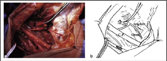 Fig. 7. a, b. Curage monobloc central et latéral droit contrôlant les territoires  jugulocarotidiens moyen et inférieur, les régions sus-claviculaire et cervicale  transverse (veine jugulaire interne sur lacette et parathyroïde supérieure repérée par la 
