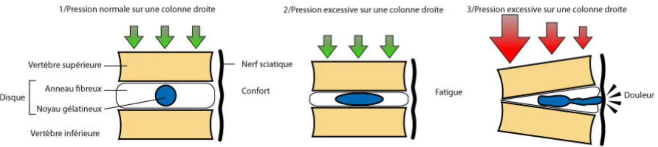 Figure 5 : image montrant les déformations des composantes discales sous différentes  pressions [33] 
