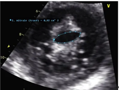 Figure 2. Incidence parasternale petit axe permettant la mesure de la  surface mitrale par planimétrie