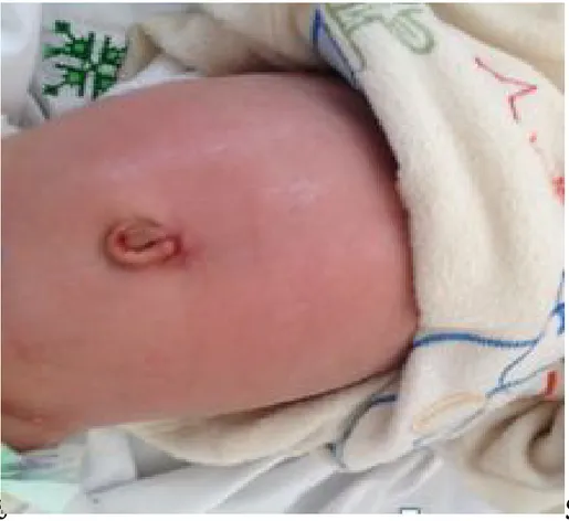 Figure 10 : Aspect de l’ombilic après un mois chez un nourrisson   opéré par voie transombilicale 