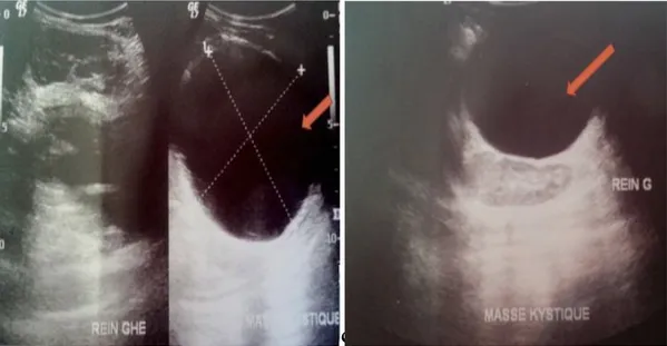 Figure 16 : Echographie abdominale montrant :une volumineuse lésion kystique abdomino- abdomino-pelvienne , bien limitée de contours réguliers ,anéchogène homogène mesurant 94/90mm 
