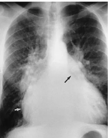 Figure 3 : Radiographie thoracique de face montrant un RM serré   avec aspect en double contour