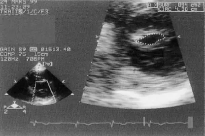 Figure 4 : Rétrécissement mitral serré. Vue en échocardiographie transthoracique en coupe  parasternale petit axe avec planimétrie de l’orifice mitral