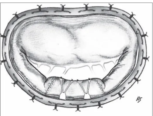 Figure 7 : Technique de préservation de la valve postérieure en cas de prolapsus postérieur,  les cordages secondaires réimplantés apparaissent en pointillé