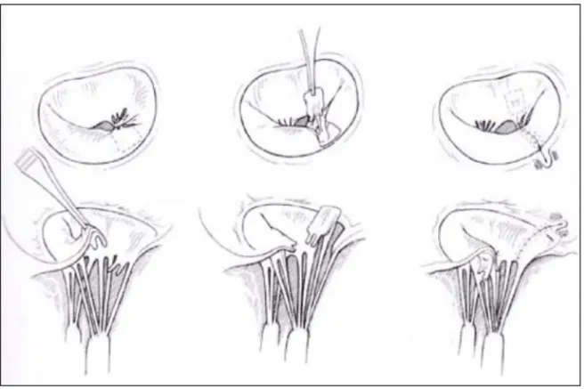 Figure 8 : Plastie mitrale: Transposition de cordages pour prolapsus du feuillet  antérieur [22] 