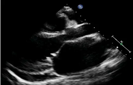 Figure 5 :IM rhumatismale : Incidence parasternale grand axe montrant une petite valve  mitrale figée avec un aspect de faux prolapsus de la grande valve