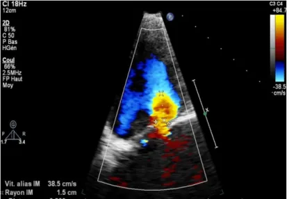 Figure 6: Evaluation de la sévèrité de l’IM au Doppler couleur par la mesure de la largeur  de la Vena contracta