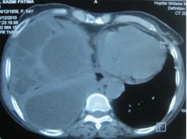 Figure 2 : Scanner thoracique montrant une pleurésie droite enkystée et multi-cloisonné