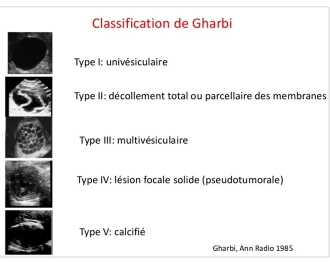 Figure 6 : classification échographique de Gharbi simplifié [15].  