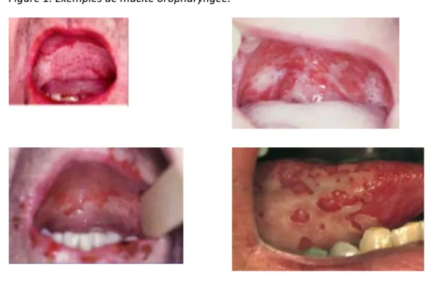 Figure   1.   Exemples   de   mucite   oropharyngée.   