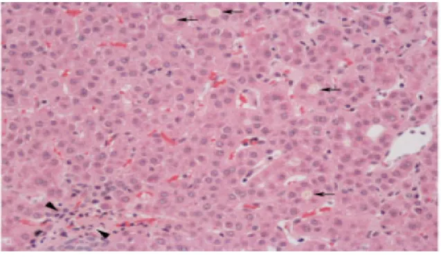 Figure 2 : Biopsie hépatique d’une fille de 6 ans atteinte de PFIC 1 montrant une bande de  cholestase canaliculaire avec des pseudo rosettes et une inflammation minimale.(7)  Illustration extraite du Morotti Raffaella, SuchyFrederick, Magid Margretlivre ,