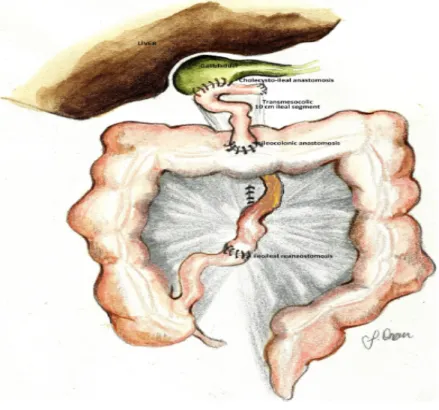 Figure 9 : Schéma montrant l’anastomose cholécysto-iléo-colique lors d’une DBPI. 