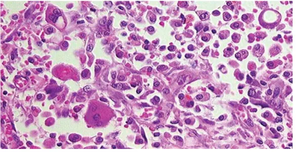 Figure 12 : infiltration des macrophages, neutrophiles et lymphocytes  avec des histiocytes