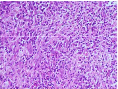 Figure 14 : Infiltration des macrophages mélangés avec d'autres types de cellules  inflammatoires et des fibroblastes dispersés