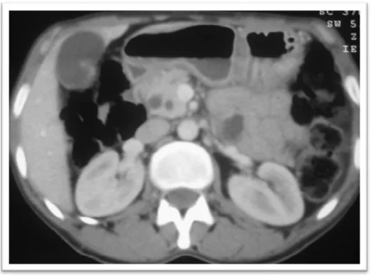 Figure 15 : TDM abdominale C+ montrant la tête du pancréas avec dilatation bicanalaire  terminale du Cholédoque et du Wirsung