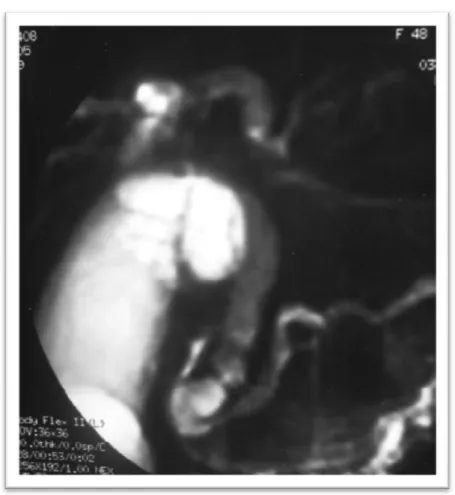 Figure 17 : Bili IRM montrant une grosse vésicule biliaire dilatée et une dilatation de la voie  biliaire principale en amont d’une sténose irrégulière du bas cholédoque