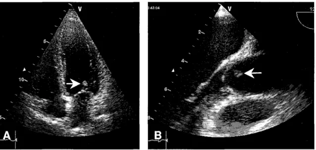 Figure 7. Echocardiographie chez une patiente présentant un syndrome des antiphospholipides (SAPL) (Remerciements aux Drs Selton-Suty et Bruntz - CHU de Nancy)