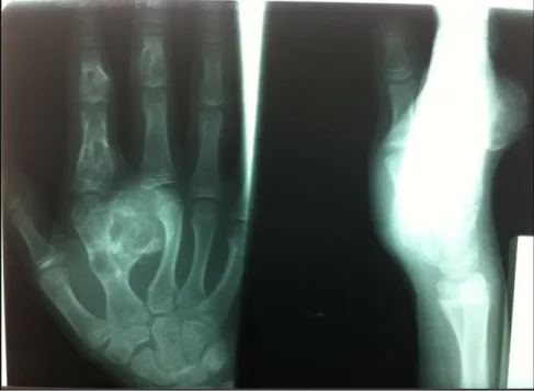 Figure 6 : Radiographie de la main droite face et profil, d’un enfant de 11 ans, montrant une  chondromatose multiple, siégeant au niveau du métacarpe  du 2 ème  doigt, et sur la  1 ère  et  la deuxième 