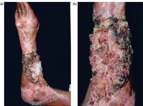 Figure  22: Tumeurs Noir         pigmentée              de  la  peau  en         fleur  sur  le  moignon        d'amputation                    de l'index  gauche  [97] 