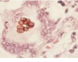 Figure 34 : Cellules fumagoïdes à            l’intérieur de cellules géantes,         coloration  à          safran (×400) [65]