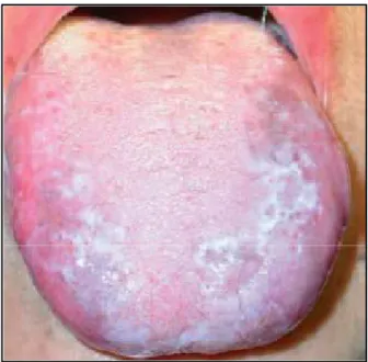 Figure 11 : Vue endobuccale. Lichen plan réticulé sur la muqueuse gingivale. 