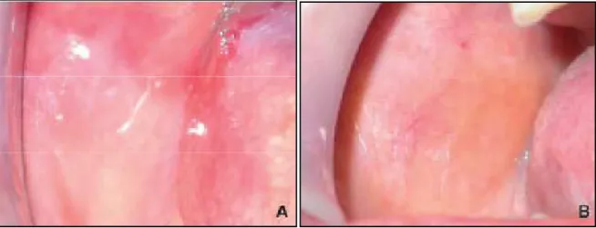 Figure 15: A et B : Vue endobuccale. Lichen plan atrophique sur la muqueuse jugale. 