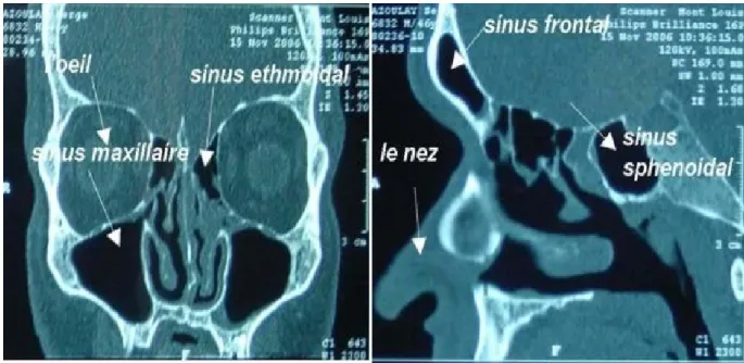 Figure 3 : Les sinus de la face. 