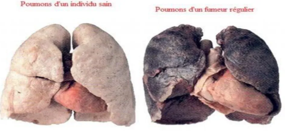 Figure 35 : Poumon d’un individu sain comparé à celui d’un fumeur régulier. 