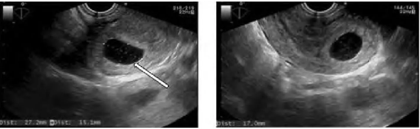 Figure 1 - Position des calipers pour la mesure du sac gestationnel en échographie 