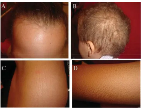 Figure 26: Syndrome d’ichtyose hypotrichose chez deux de 5 et 8 ans. 