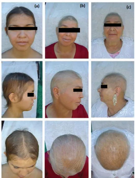 Figure 14: Aspect cliniques de HHSS chez une famille mexicaine (a) la fille 17 ans, (b) la  mère 45 ans et (c) la grand-mère 64 ans) (54) 