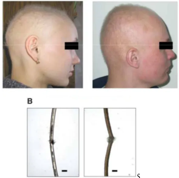 Figure 21: Présentation clinique du défaut de croissance des cheveux et de l'alopécie  chez les individus de Chuvash (68) 