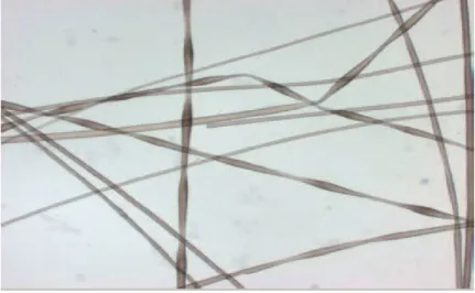 Figure 9 : Monilethrix : nodosités uniformes et rétrécissements périodiques inter-  nodaux le long de la tige pilaire en microscopie optique